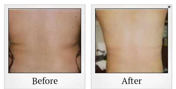Before and after liposuction result showing the abdomen and waist