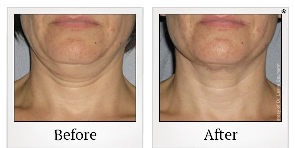Before and after Ultherapy treatment result showing the lower face and neck