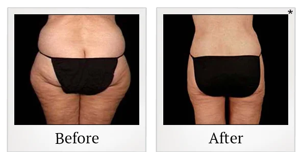 Before and after liposuction result showing the waist and hip area