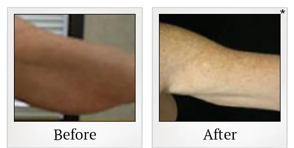 Before and after liposuction result showing the upper arm