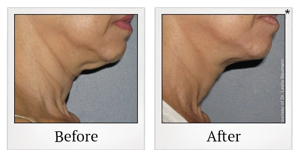 Before and after Ultherapy treatment result showing the neck and jawline