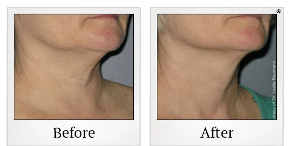 Before and after Ultherapy treatment result showing the under-chin area