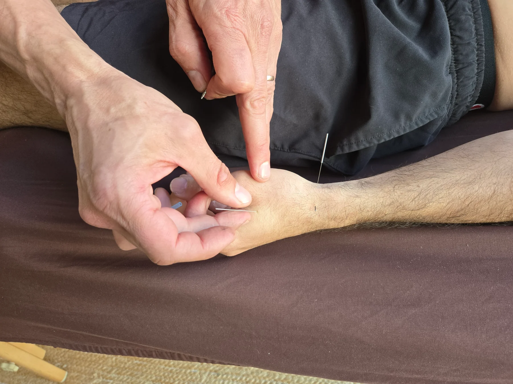 Close view of Jason placing fine acupuncture needles at a patient's hand and wrist